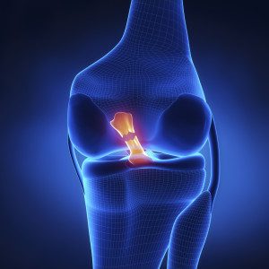 Torn anterior cruciate ligament. Athletes who undergo ACL surgery often suffer another ACL injury within 2 years.