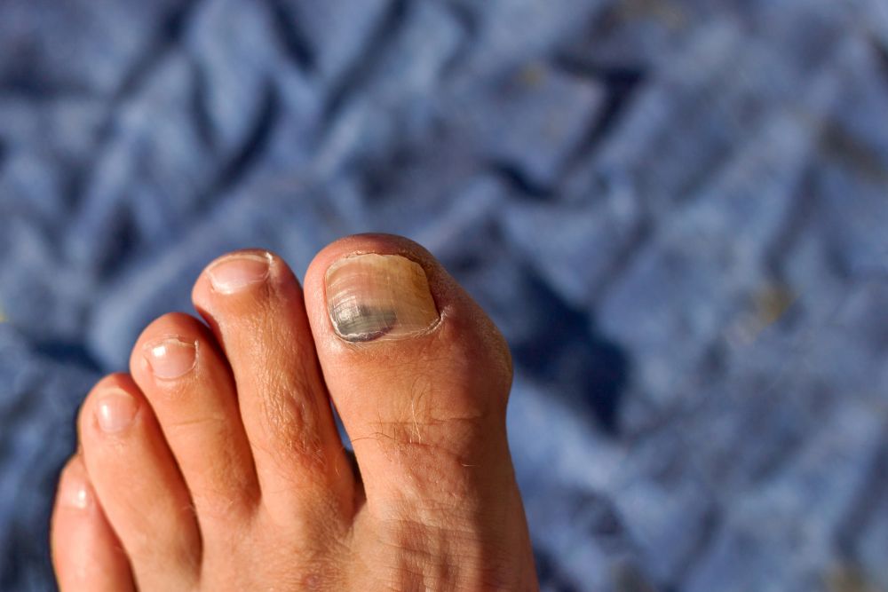 The nine types of toenails you will find in the running scene... - Canadian  Running Magazine